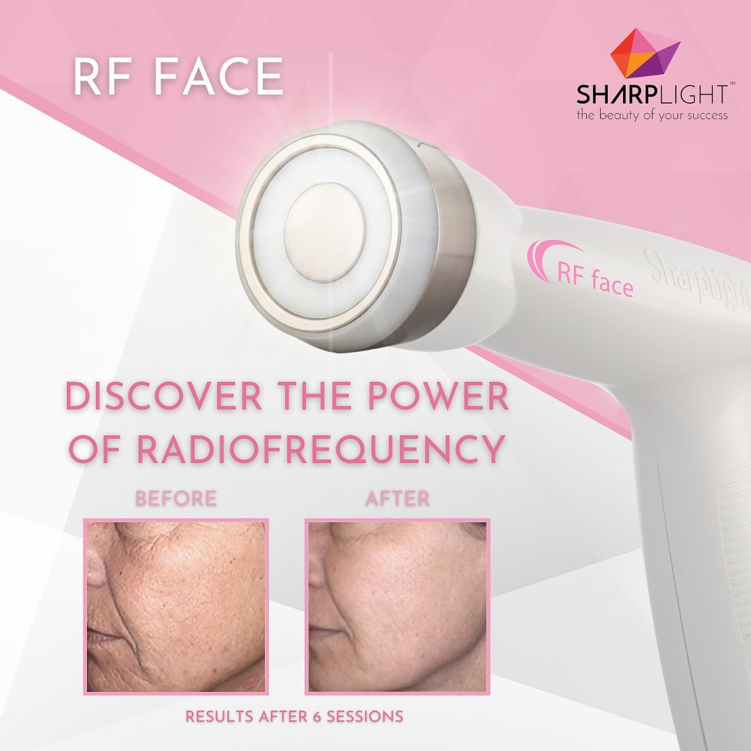 Radio frequency facial contouring treatment